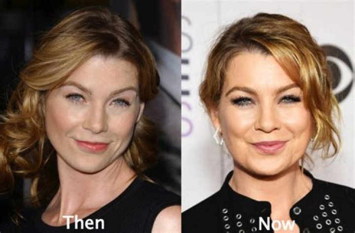 Ellen Pompeo Plastic Surgery Before and After Botox Injections